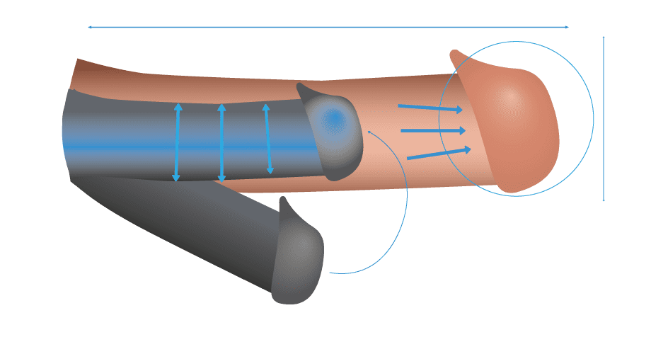 precio de agrandamiento de pene