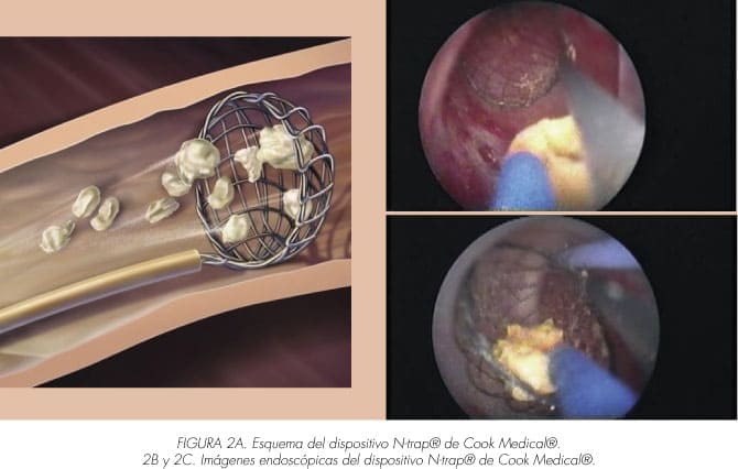 operacion piedras en riñones