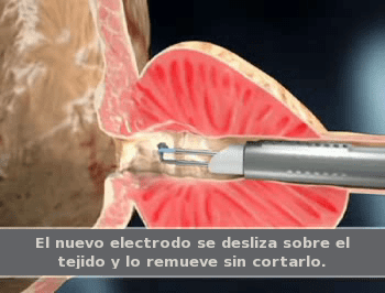 precio rtup prostata