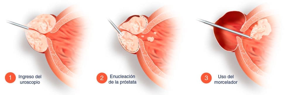 tratamiento de prostata
