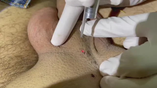 eliminacion de verrugas genitales